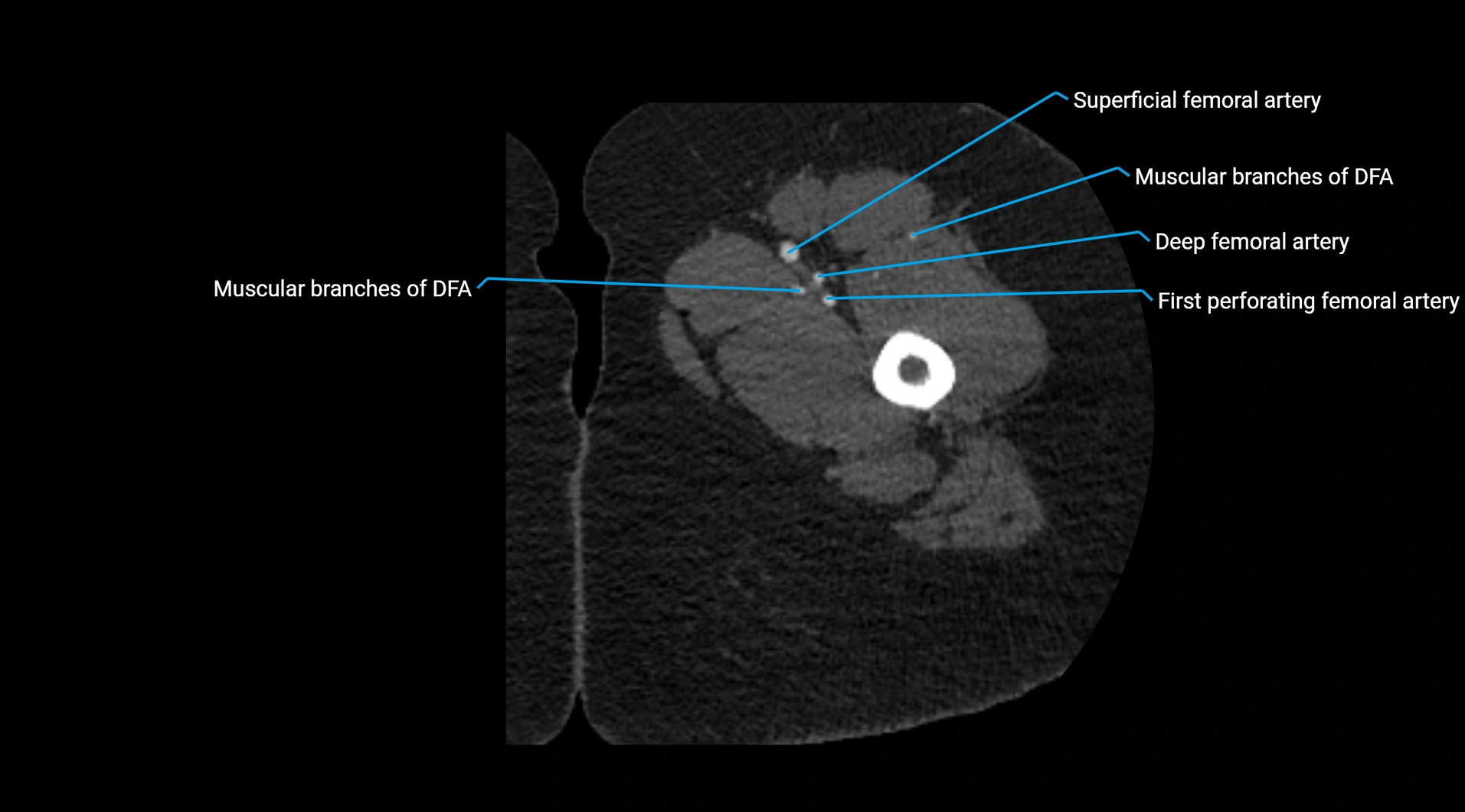 CTA lower limb cross sectional anatomy labelled image _90.webp